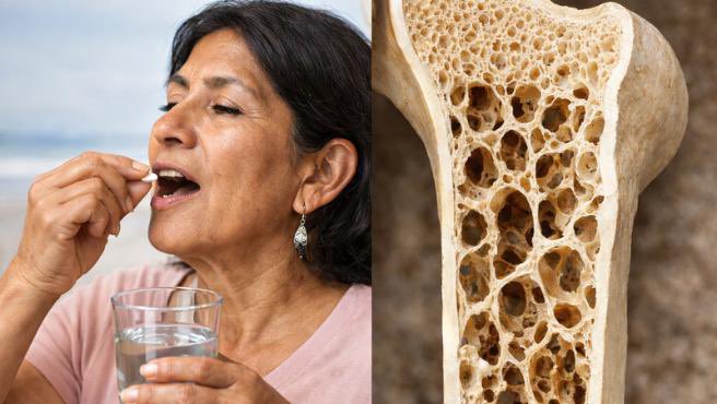 DIGEMID ALERTA SOBRE EL RIESGO DE OSTEOPOROSIS ASOCIADA AL USO INADECUADO DE MEDICAMENTOS